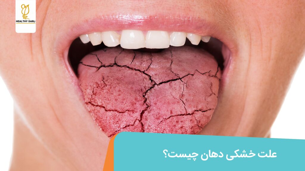 خشکی دهان چیست؟ داروخانه آنلاین هلثی دارو