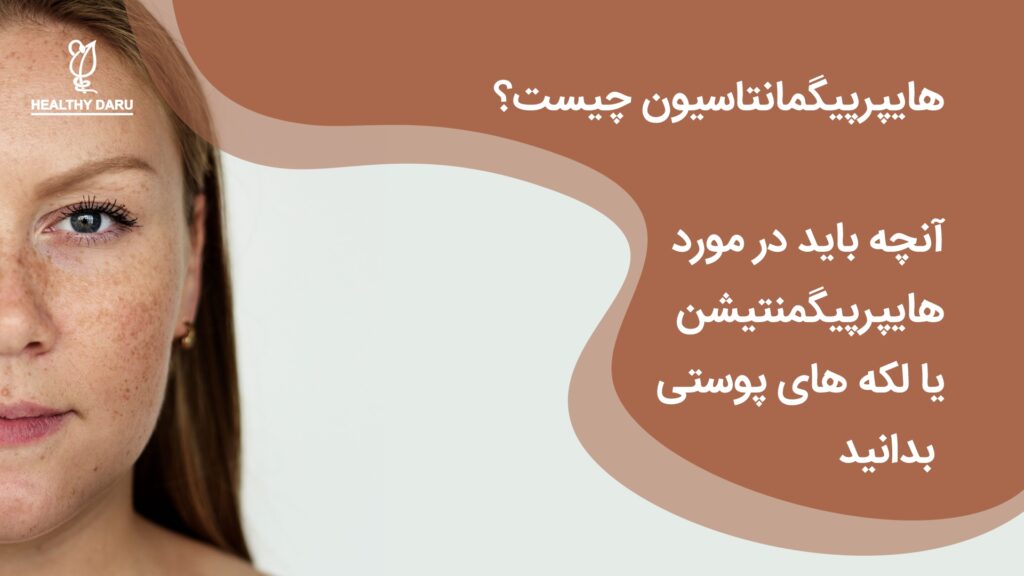 هایپرپیگمانتاسیون چیست و چگونه درمان میشود؟ داروخانه آنلاین هلثی دارو