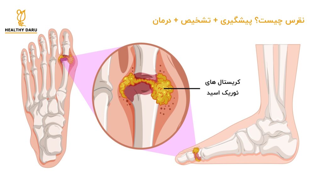نقرس چیست؟ پیشگیری + تشخیص + درمان - هلثی دارو