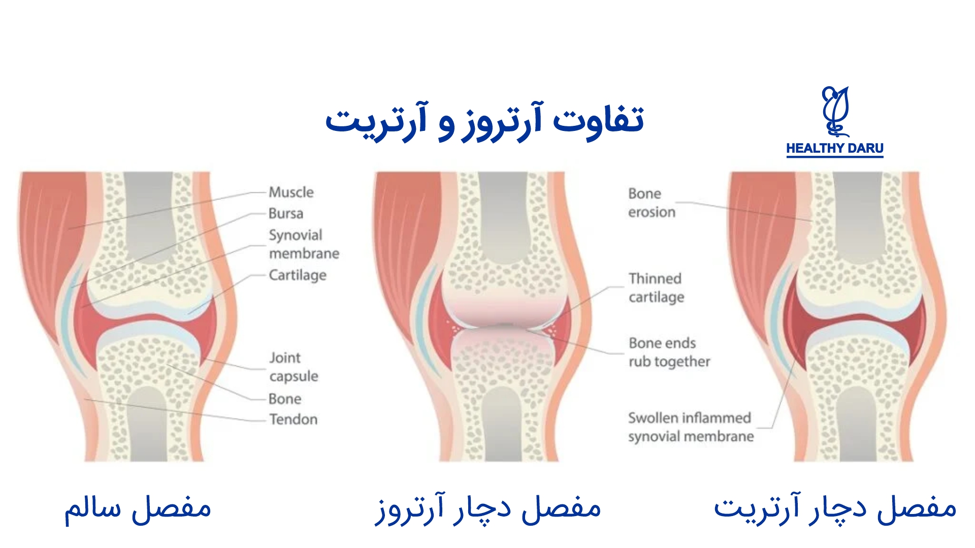 تفاوت آرتریت و آرتروز چیست؟
