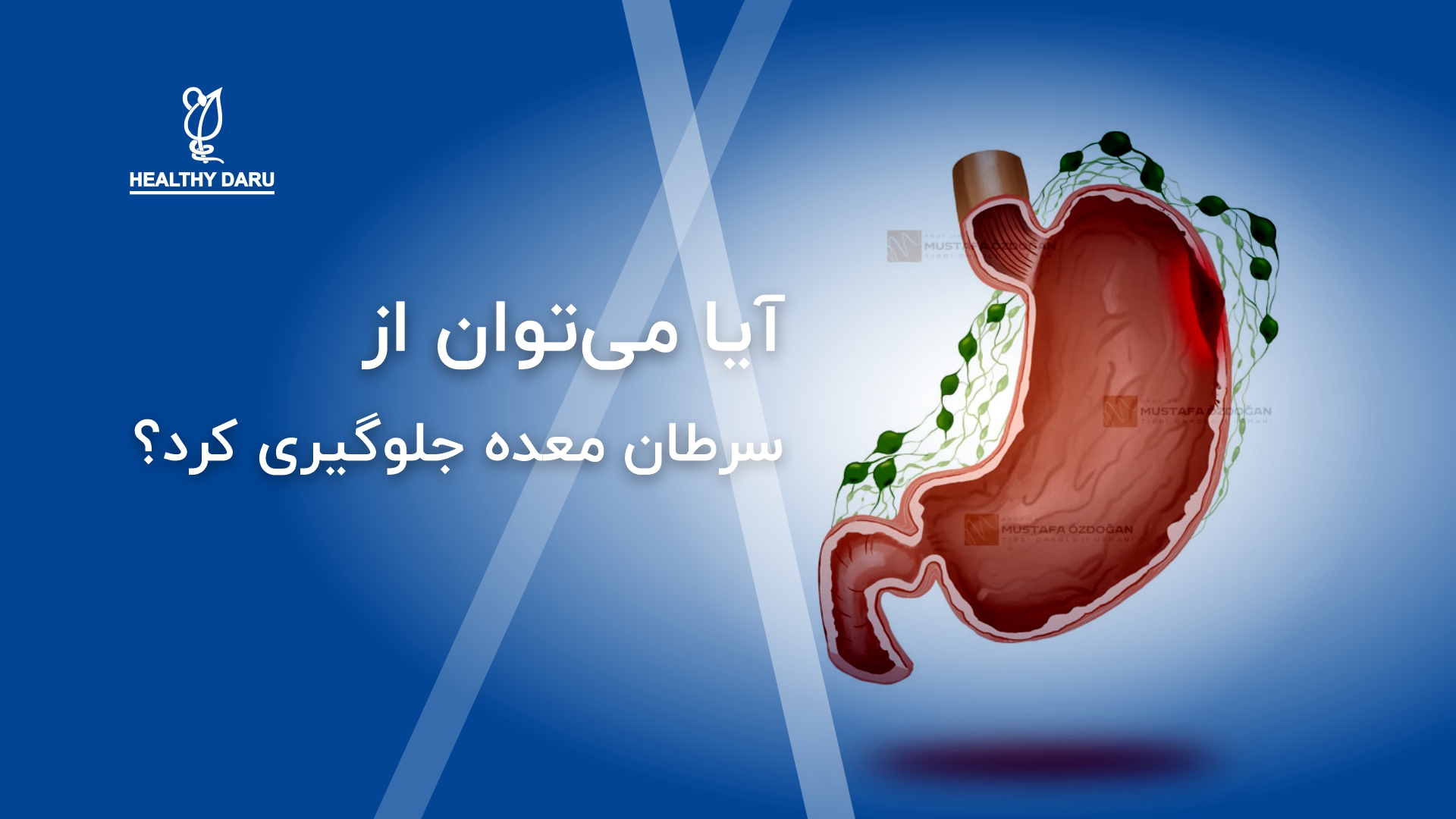 آیا میتوان از سرطان معده جلوگیری کرد؟