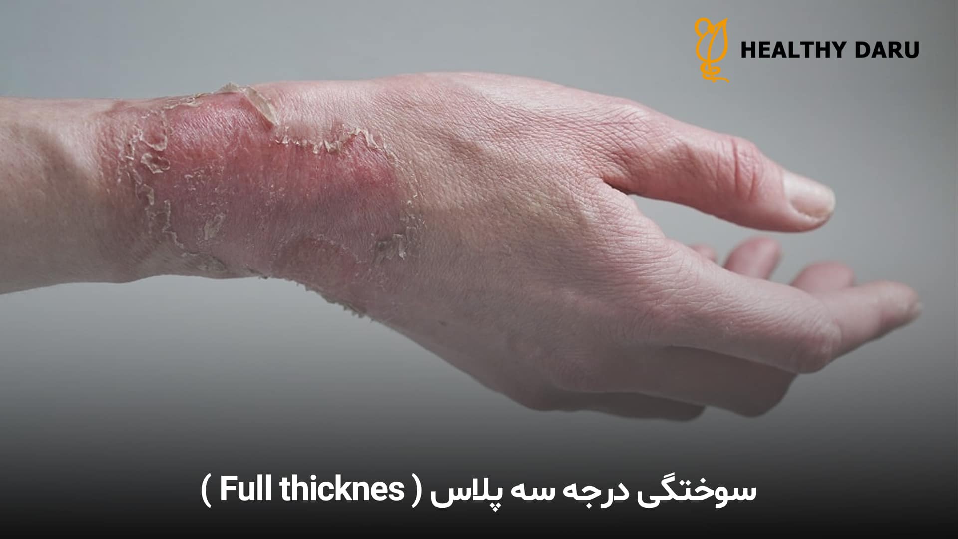 سوختگی درجه سه شدیدترین نوع سوختگی است که تمام لایههای پوست و گاهی بافتهای زیرین مانند چربی، عضله یا استخوان را تخریب میکند. این نوع سوختگی معمولاً بدون درد است چون پایانههای عصبی آسیبدیده اند و نیاز به درمان فوری پزشکی دارد. سوختگی درجه سه چیست؟