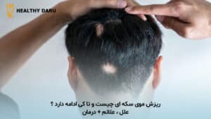 ریزش مو سکه ای چیست و تا کی ادامه دارد؟ علل، علائم + درمان داروخانه آنلاین هلثی دارو