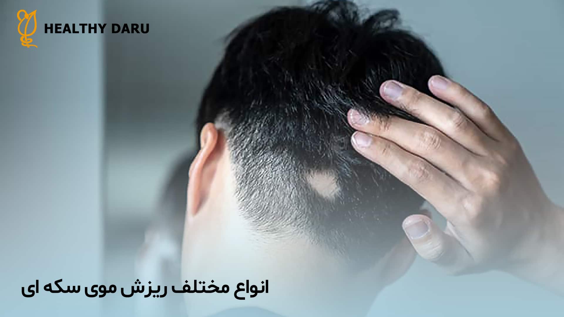 ریزش موی سکه ای چه انواعی دارد؟