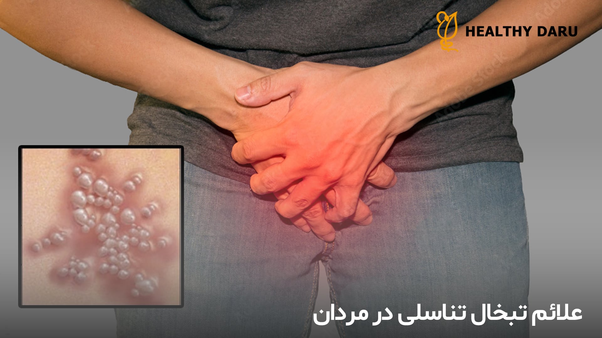 علائم تبخال تناسلی در مردان چیست؟