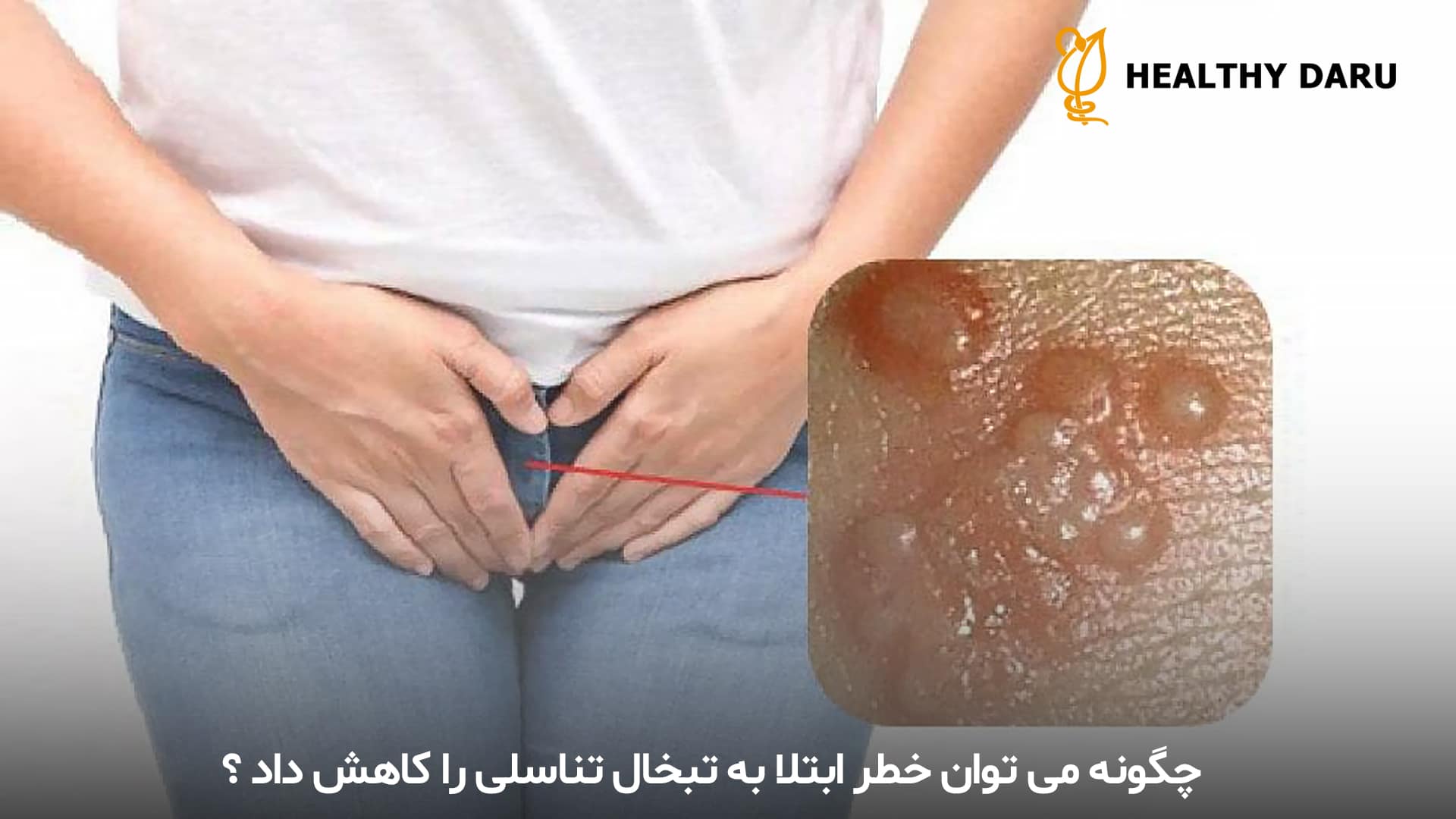 جگونه از ابتلا به تبخال تناسلی جلوگیری کرد؟