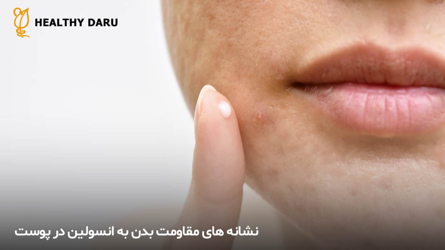 نشانه های پوستی مقاومت به انسولین - داروخانه آنلاین هلثی دارو