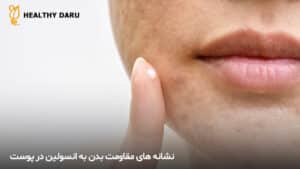 نشانه های پوستی مقاومت به انسولین - داروخانه آنلاین هلثی دارو
