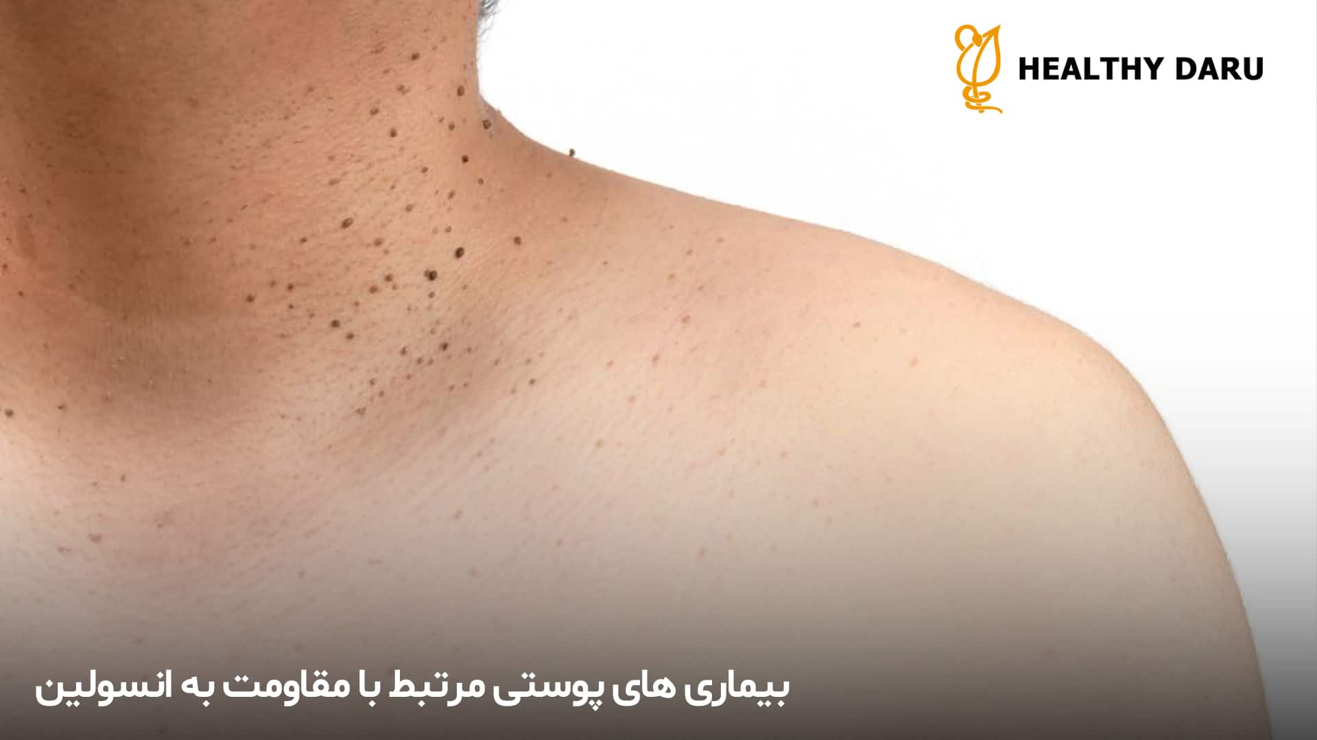 چه بیماری های پوستی ای با مقاومت به انسولین ارتباط دارند؟