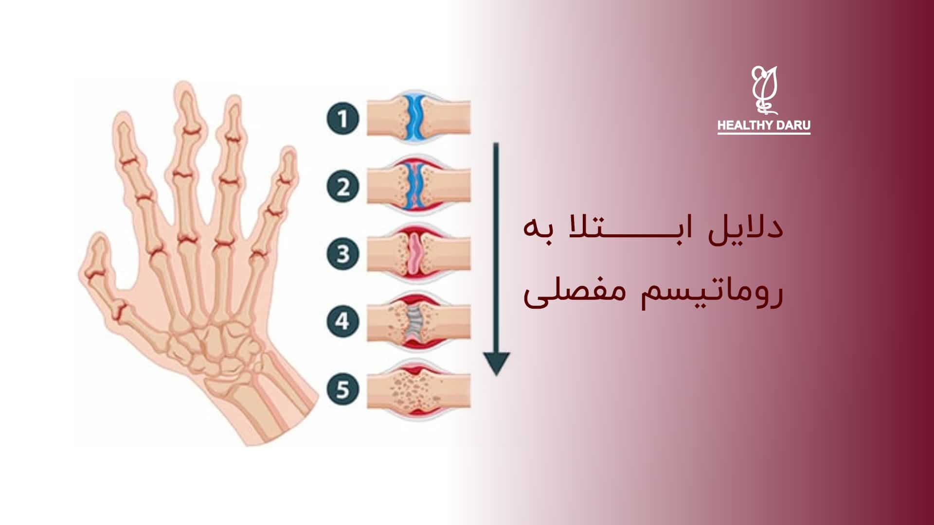 ابتلا به رماتیسم مفصلی چه دلایلی دارد؟